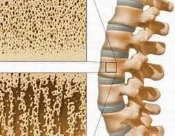 Calcium deficiency - the leading cause of osteoporosis and musculoskeletal diseases