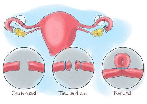 Does tubal ligation affect the menstrual cycle?