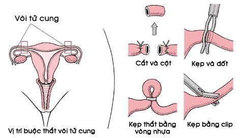 
Quy trình thực hiện thắt ống dẫn trứng
