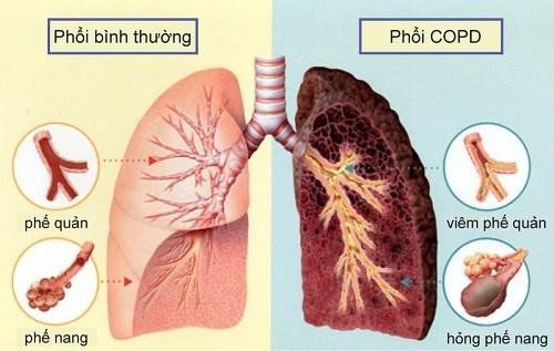 
Hình ảnh phổi bị tổn thương do bệnh phổi tắc nghẽn mãn tính
