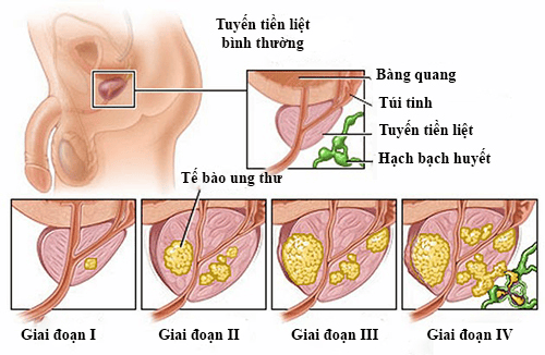 
Các giai đoạn phát triển của ung thư tiền liệt tuyến
