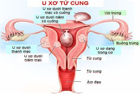 
Cường kinh có thể là biểu hiện của bệnh u xơ tử cung
