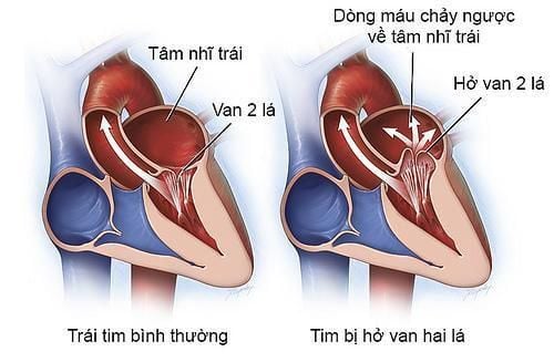 
Hở van 2 lá là bệnh lý tim mạch thường gặp
