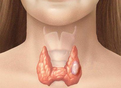 How to detect and treat thyroid cancer