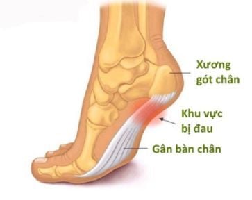 
Viêm cân gan chân có thể được phát hiện qua lâm sàng hoặc chẩn đoán hình ảnh
