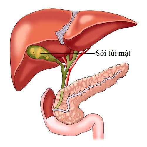 
Túi mật cũng là nơi rất dễ hình thành sỏi
