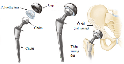 Phòng ngừa trật khớp háng sau thay khớp háng