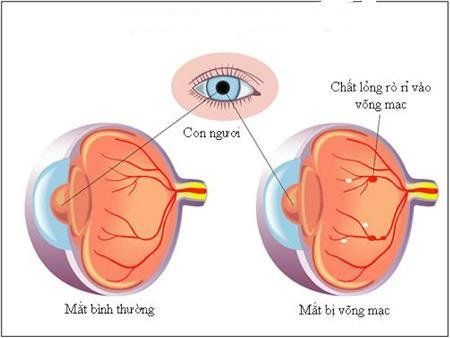 
Biến chứng võng mạc mắt do bệnh đái tháo đường.
