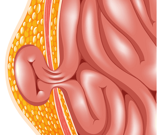 
Bệnh sa ruột ở trẻ em cần được điều trị sớm
