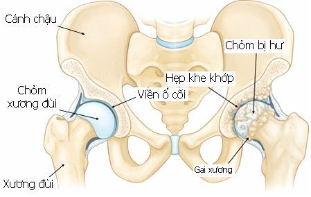 Tình trạng thoái hóa khớp háng là bệnh lý chủ yếu gặp ở người lớn tuổi 