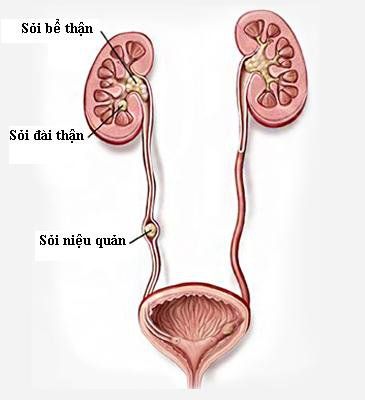 
Sỏi niệu quản
