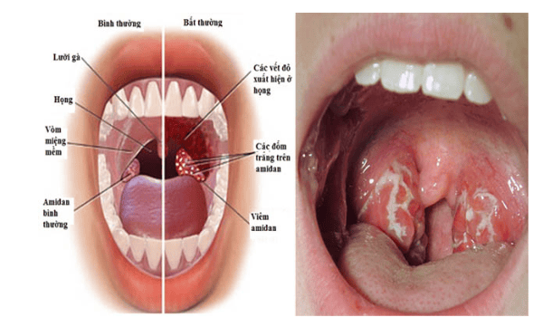 Cách điều trị viêm amidan