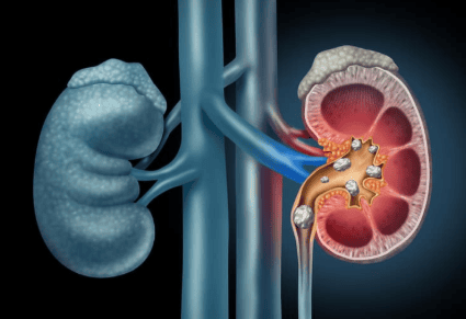 Diet for patients with urolithiasis