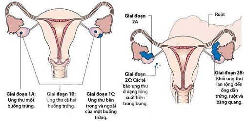 
Ung thư buồng trứng giai đoạn 1 và 2
