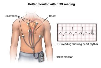 
Holter điện tâm đồ
