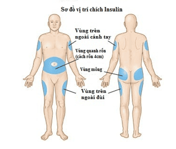 
Sơ đồ vị trí tiêm Insulin trên cơ thể
