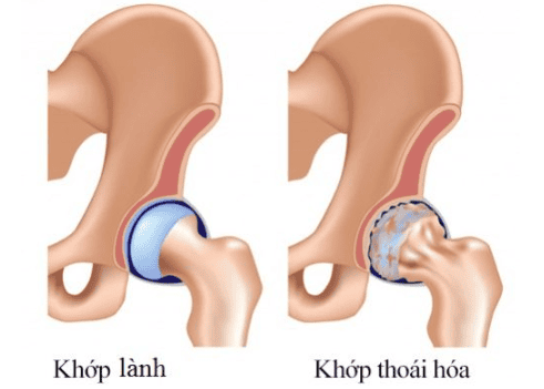 
Người bệnh gặp tình trạng thoái hóa khớp háng cần được thay toàn bộ khớp háng
