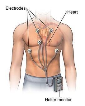 
Thời gian đeo máy Holter điện tâm đồ dao động từ 24-48h để có kết quả chính xác
