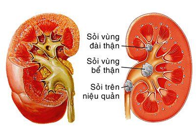 What are the stages of urinary stone formation?