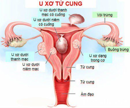 
U xơ tử cung có thể dẫn tới rong kinh
