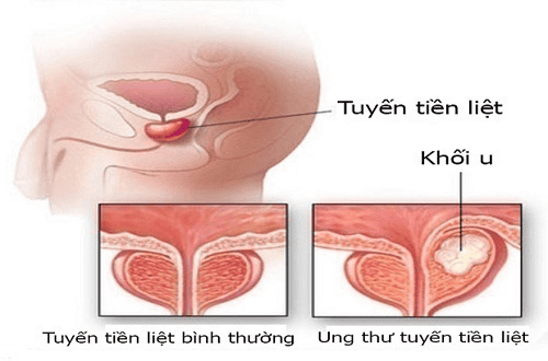 
Ung thư tiền liệt tuyến là bệnh thường gặp ở nam giới
