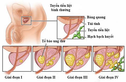 
Các giai đoạn ung thư tuyến tiền liệt
