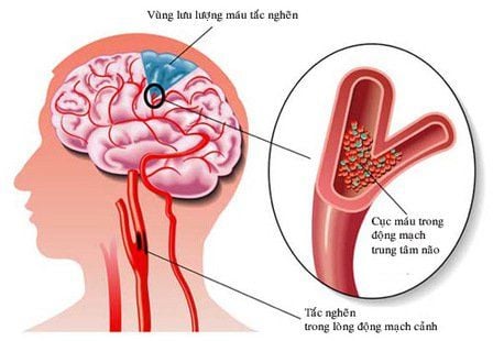 
Cục huyết khối nhỏ gây cản trở lưu thông máu đến một số vùng não của bệnh nhân
