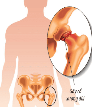 
Vị trí gãy cổ xương đùi
