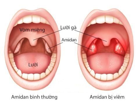 At what age is acute tonsillitis common?