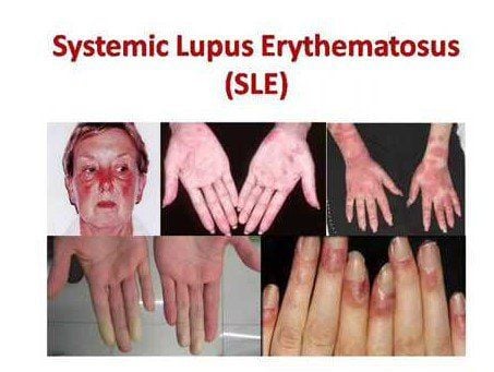 
Bệnh nhân lupus ban đỏ thường có ban đỏ bất thường trên da
