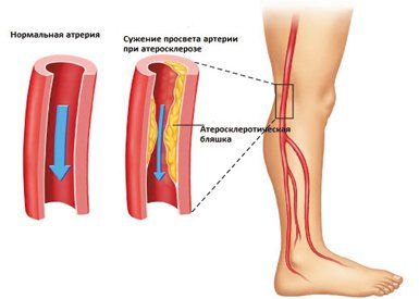 Peripheral vascular disease includes which diseases? Causes and warning symptoms