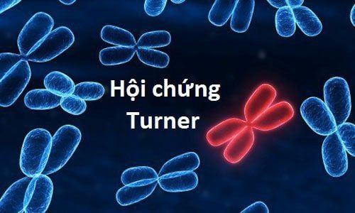 
Xét nghiệm Karyotype có thể chuẩn đoán Hội chứng Turner
