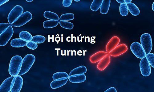 
Hội chứng Turner cần được xét nghiệm và phát hiện sớm
