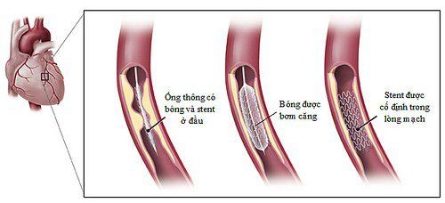 
Các bước đặt stent động mạch vành
