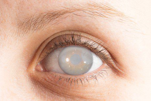 Cataracts: Should be operated early, do not hesitate