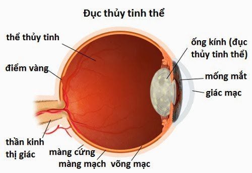 
Hình ảnh đục thủy tinh thể
