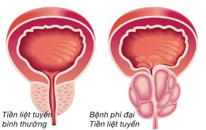 Trọng lượng tiền liệt tuyến: Tìm hiểu chi tiết về kích thước và sức khỏe