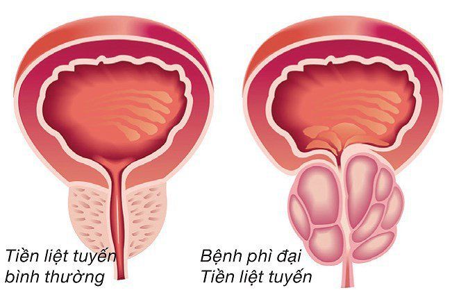 Tiền liệt tuyến bao nhiêu gam là bình thường?