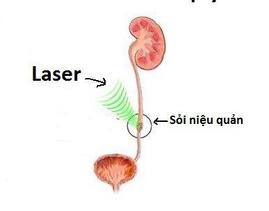 
Nội soi tán sỏi niệu quản bằng laser có thể tán được mọi loại sỏi, cả những sỏi có kích thước lớn và nằm ở vị trí khó
