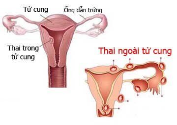 
Hiện tượng thai ngoài tử cung chủ yếu xảy ra ở ống dẫn trứng (vòi trứng)
