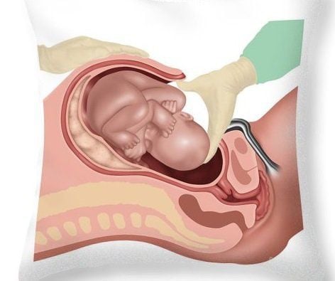 
The mother has a small or narrow pelvic structure
