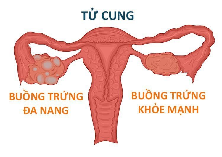 Bệnh buồng trứng đa nang là gì? Nguyên nhân, triệu chứng và cách điều trị