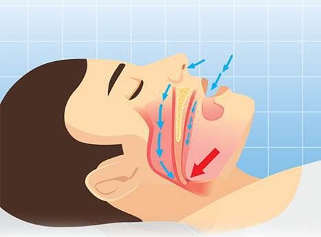 
Nguyên nhân gây ngủ ngáy do các vấn đề trong cơ vùng họng và cơ lưỡi
