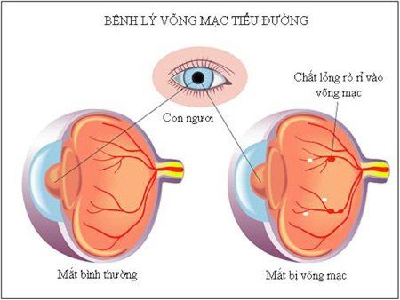 
Bệnh tiểu đường lâu năm không điều trị sớm có thể gây ra các bệnh nguy hiểm ở mắt
