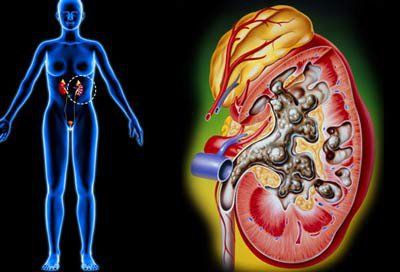 Complications of acute - chronic pyelonephritis