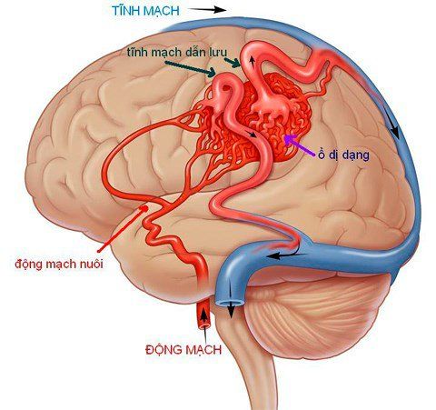 Phát hiện bệnh dị dạng mạch máu não khi đi khám đau đầu