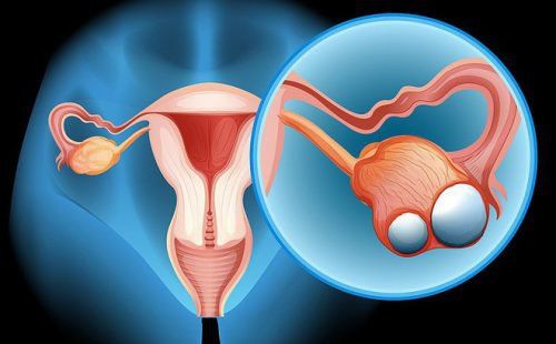 Laparoscopic surgery - a good solution for patients with early ovarian cancer