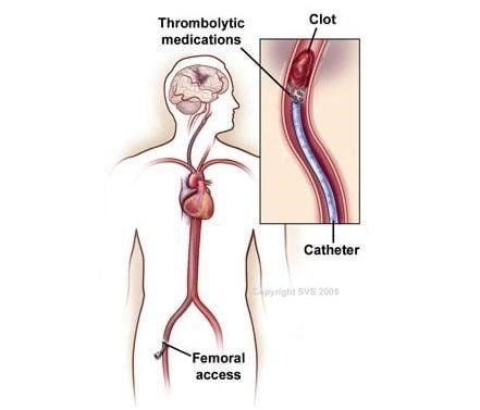 
Phác đồ điều trị huyết khối tĩnh mạch sâu bằng thuốc tan huyết khối
