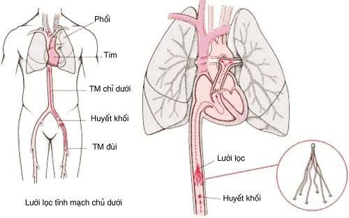 
Phẫu thuật đặt lưới lọc tĩnh mạch chủ điều trị huyết khối tĩnh mạch sâu
