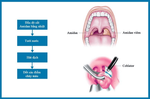 
Cắt amidan bằng máy Coblator
